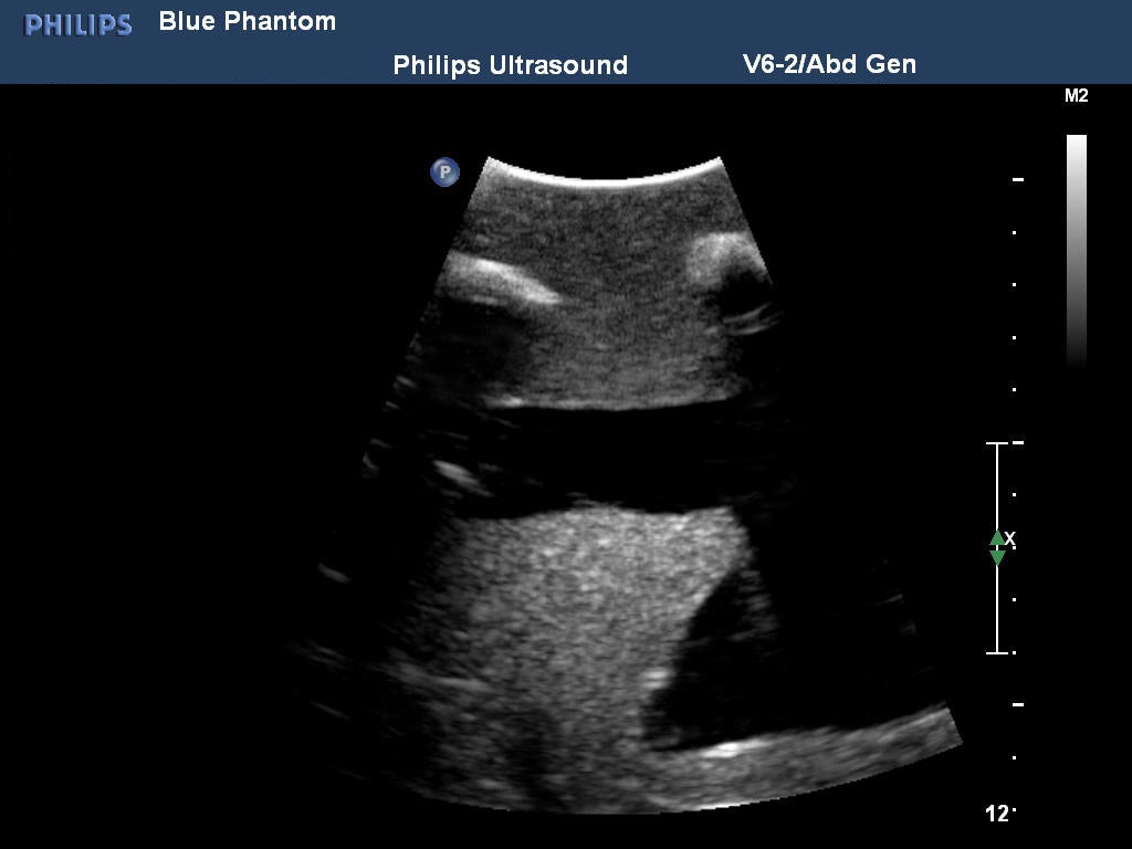 BluePhantom udskiftningsvæv til thoracentese ultralyds-træningsmodel