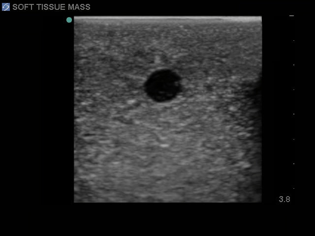 Blue Phantom Elastography Ultrasound Breast Phantom