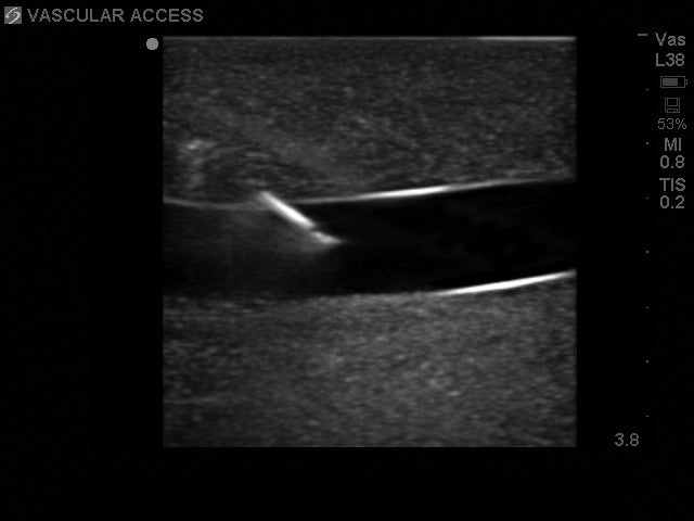 Blue Phantom Gen II udskiftningsvævsindsats til ultralyds-CVK-træningsmodel