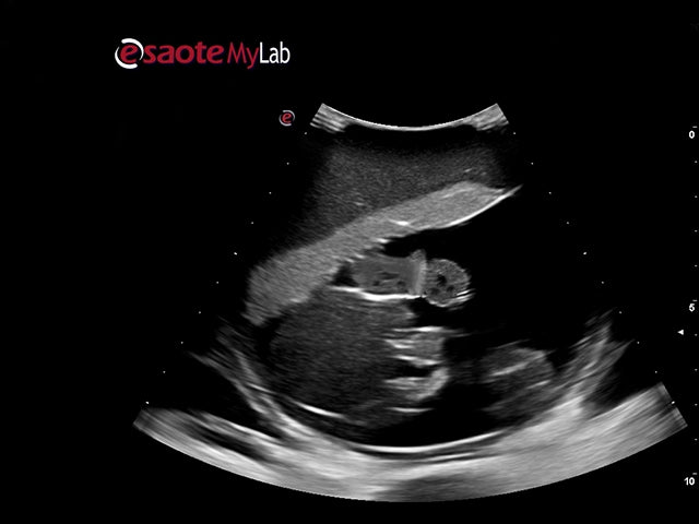 Blue Phantom Ultrasound Training Model Percutaneous Umbilical Cord Blood Sampling