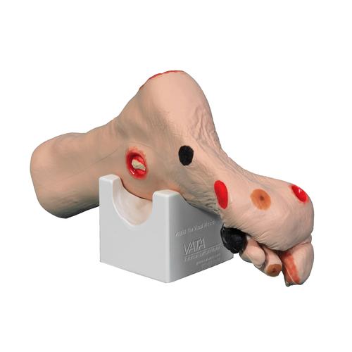 Wound treatment model Foot