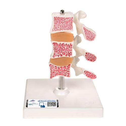 Osteoporosemodel Deluxe (3 hvirvler med diske), aftagelig på stativ