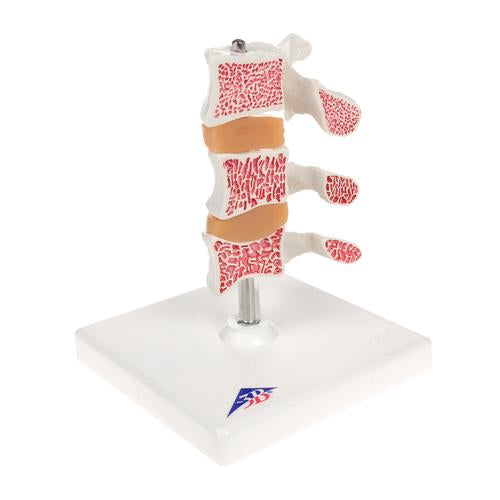 Osteoporosemodel Deluxe (3 hvirvler med diske), aftagelig på stativ – billede 2