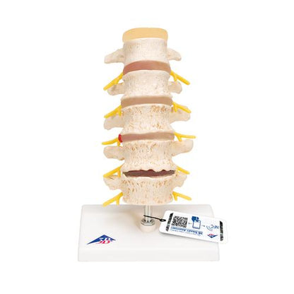Stadier af diskusprolaps og hvirveldegeneration
