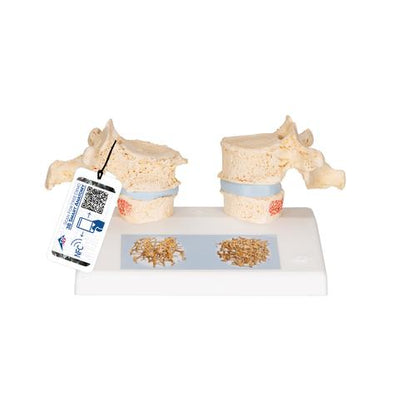 Didaktisk osteoporosemodel