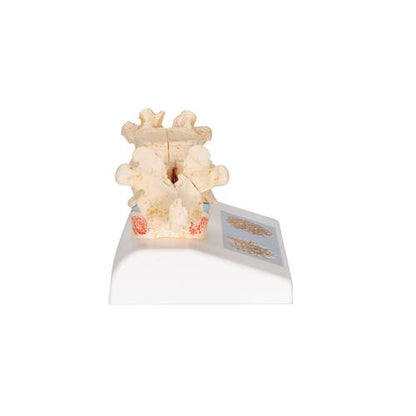 Didaktisk osteoporosemodel – billede 3