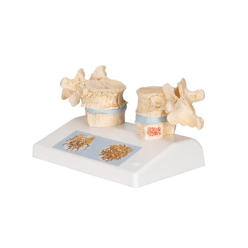 Didaktisk osteoporosemodel – billede 5