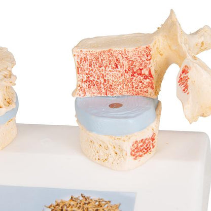 Didaktisk osteoporosemodel – billede 7