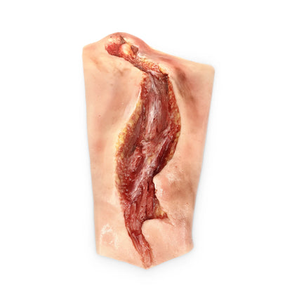 Electrical Burn Forearm 