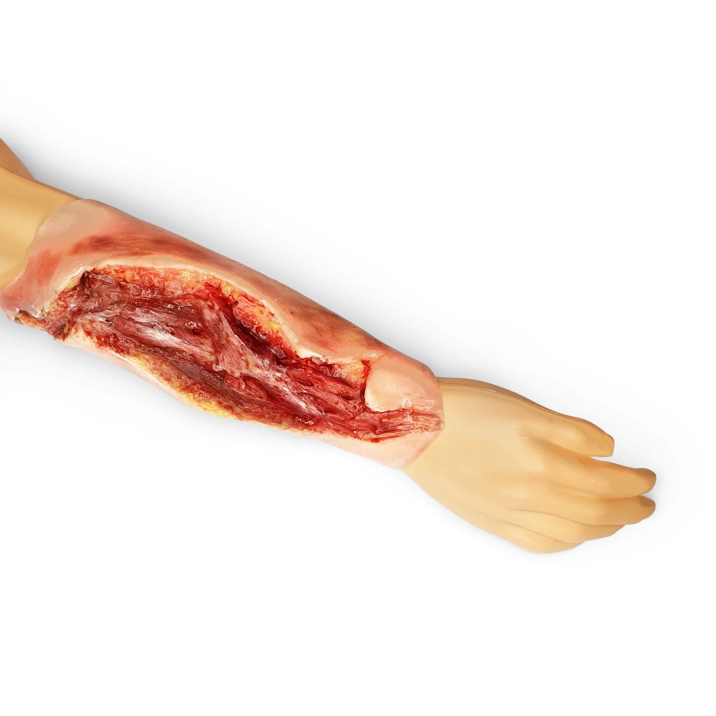 Electrical Burn Forearm 