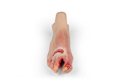 Diabetic foot ulcer, severe stage.