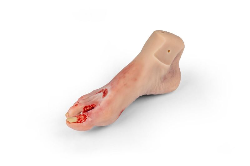 Diabetic foot ulcer, severe stage.