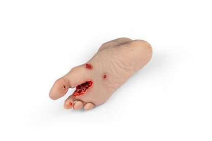 Diabetic foot ulcer, severe stage.
