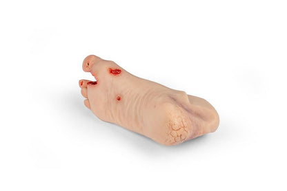 Diabetic foot ulcer, severe stage.