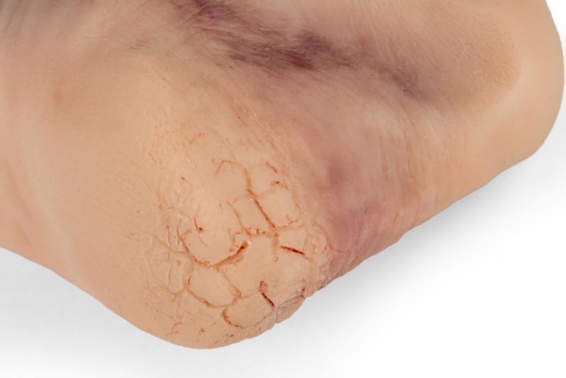 Diabetic foot ulcer, severe stage.