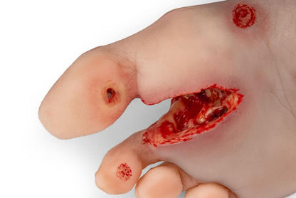 Diabetic foot ulcer, severe stage.