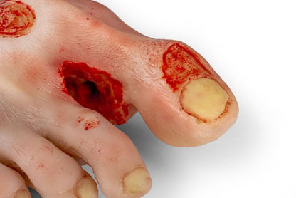 Diabetic foot ulcer, severe stage.