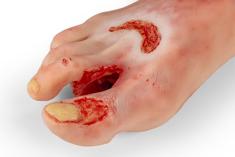 Diabetic foot ulcer, severe stage.