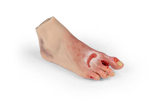 Diabetic foot ulcer, severe stage.