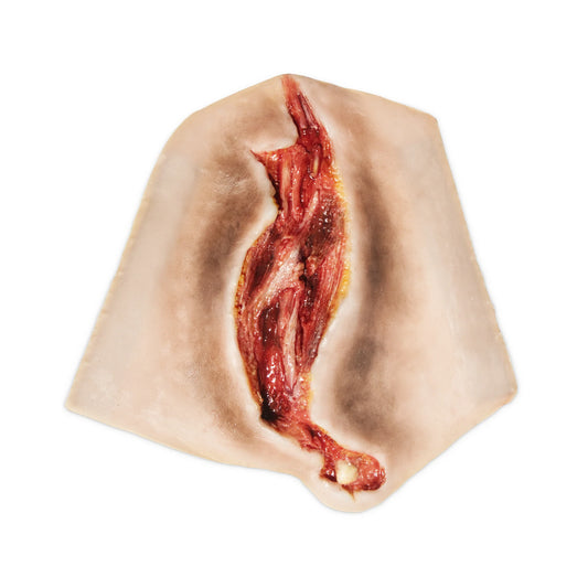 Electrical Burn Forearm 