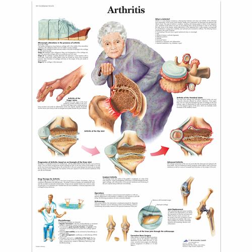 Anatomisk planche: Artritis (ledbetændelse), lamineret