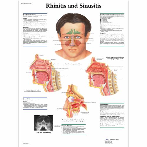 Anatomisk planche: Rhinitis og bihulebetændelse, lamineret