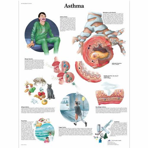 Anatomisk planche: Astma, lamineret