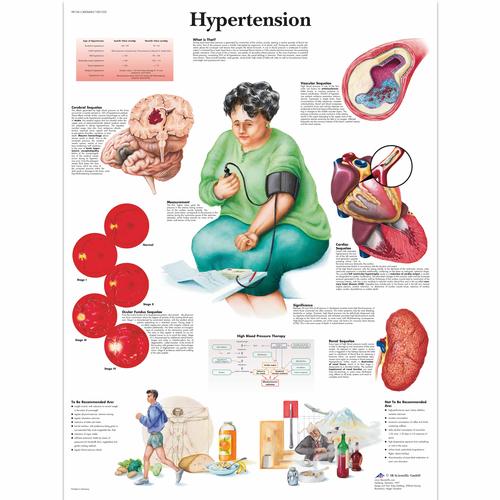 Anatomisk planche: Forhøjet blodtryk (hypertension), lamineret