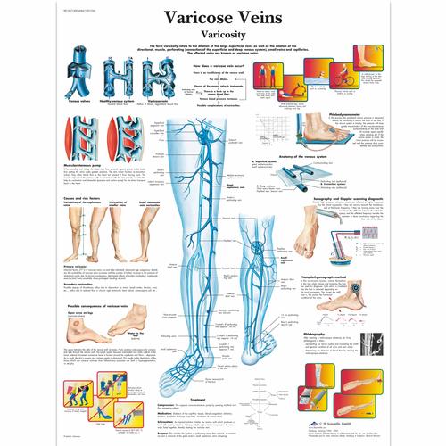 Anatomisk planche: Åreknuder, papir