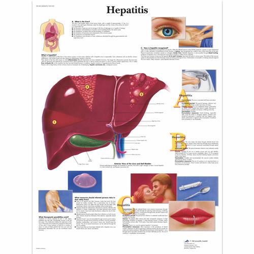 Anatomisk planche: Hepatitis (leverbetændelse), papir