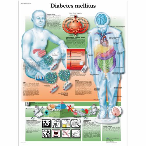 Anatomisk planche: Diabetes (sukkersyge), papir