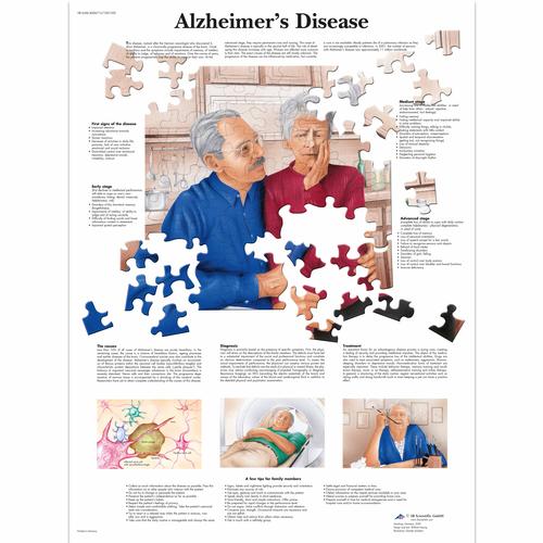 Anatomisk planche: Alzheimers sygdom, lamineret