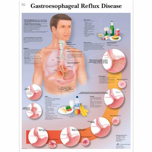 Anatomisk planche: Sur reflux og halsbrand (GERD), lamineret