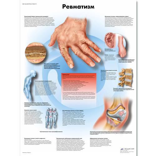 Anatomisk planche: Reumatiske sygdomme, lamineret med metaløjer