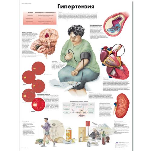 Anatomisk planche: Forhøjet blodtryk (hypertension), lamineret med metaløjer