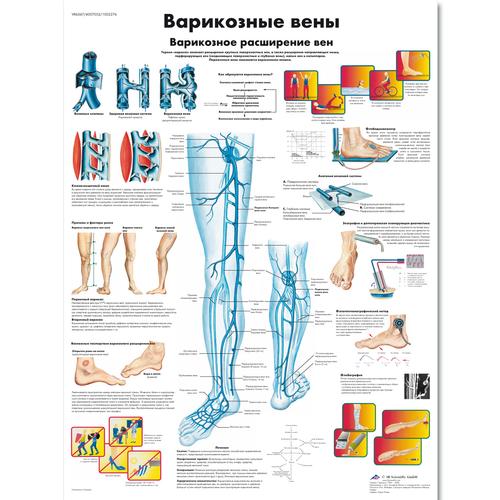 Anatomisk planche: Åreknuder, lamineret med metaløjer