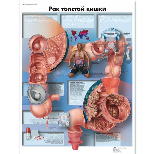 Anatomisk planche: Tyktarmskræft, lamineret med metaløjer