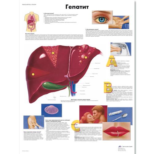 Anatomisk planche: Hepatitis (leverbetændelse), lamineret med metaløjer