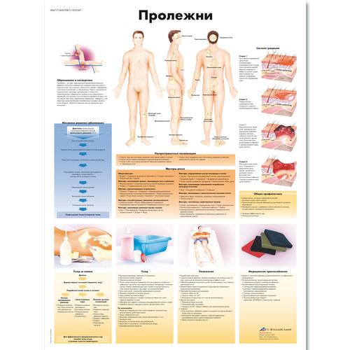 Anatomisk planche: Tryksår (decubitus), lamineret med metaløjer