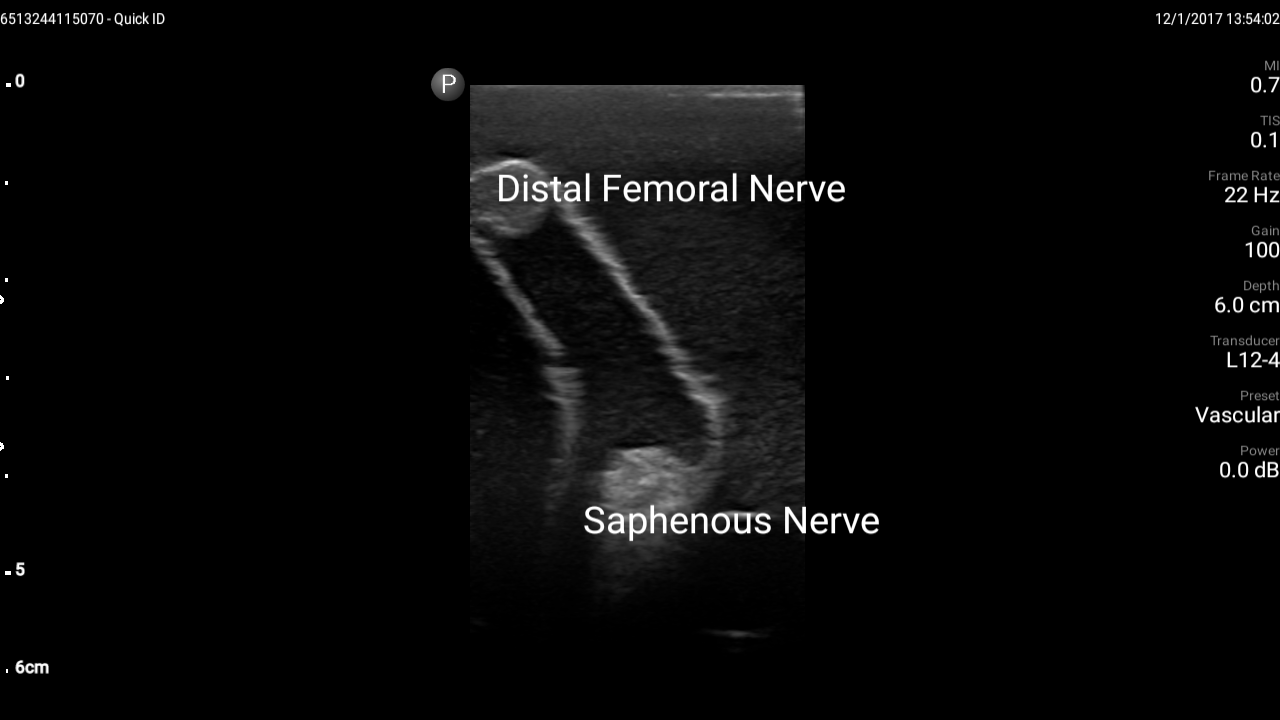 Blue Phantom Ultrasound Training Model Femoral Vascular Access and Regional Anesthesia