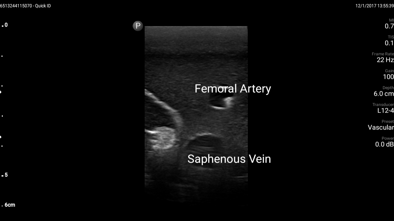 Blue Phantom Ultrasound Training Model Femoral Vascular Access and Regional Anesthesia
