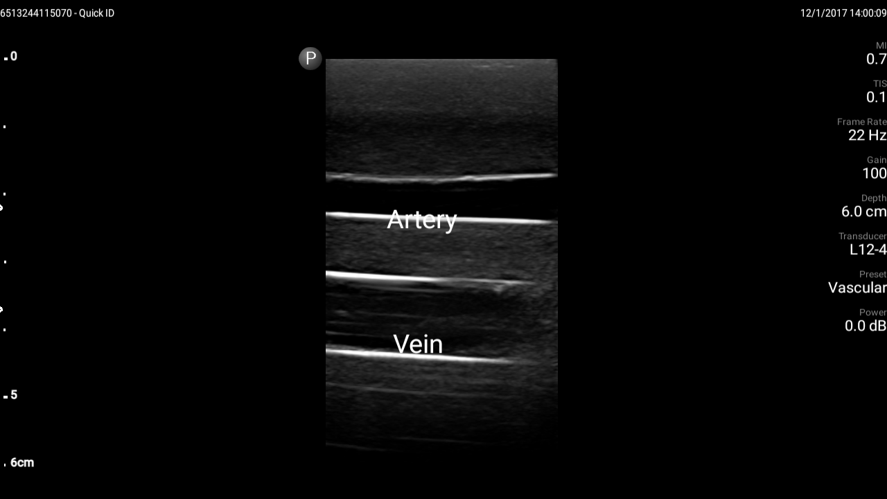 Blue Phantom Ultrasound Training Model Femoral Vascular Access and Regional Anesthesia
