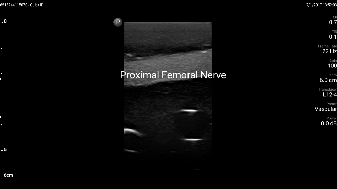 Blue Phantom Ultrasound Training Model Femoral Vascular Access and Regional Anesthesia