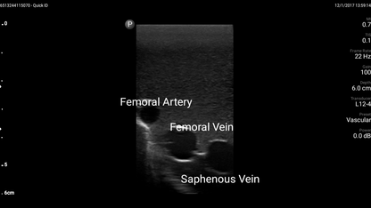Blue Phantom Ultrasound Training Model Femoral Vascular Access and Regional Anesthesia