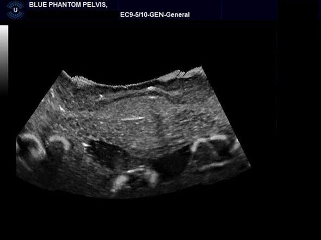 BluePhantom transvaginal ultraljudsträningsmodell för generell patologi