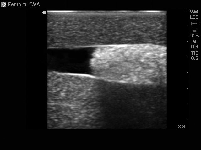 BluePhantom udskiftningsvæv til femoral kar-adgang