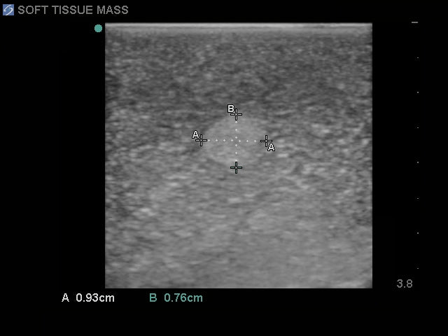 BluePhantom ultraljudsträningsmodell för bröstbiopsi