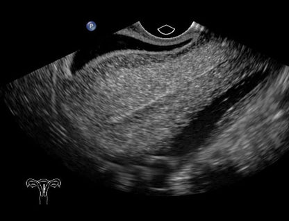 BluePhantom transvaginal ultralydstræningsmodel til sonohysterografi og sonosalpingografi