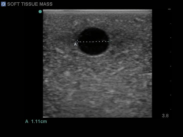 Blue Phantom Elastography Ultrasound Breast Phantom