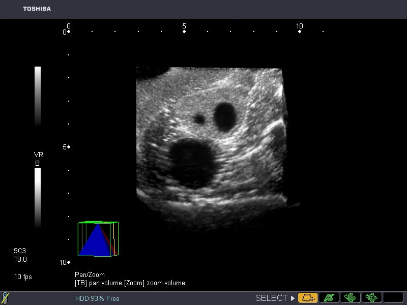 BluePhantom transvaginal ultraljudsträningsmodell för generell patologi
